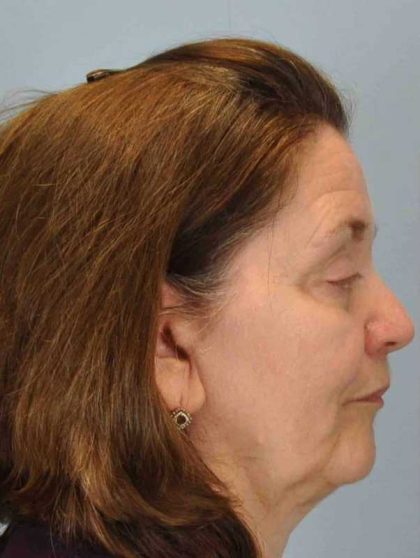 Eyelid Surgery Before & After Patient #11518