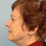 Eyelid Surgery Before & After Patient #11532