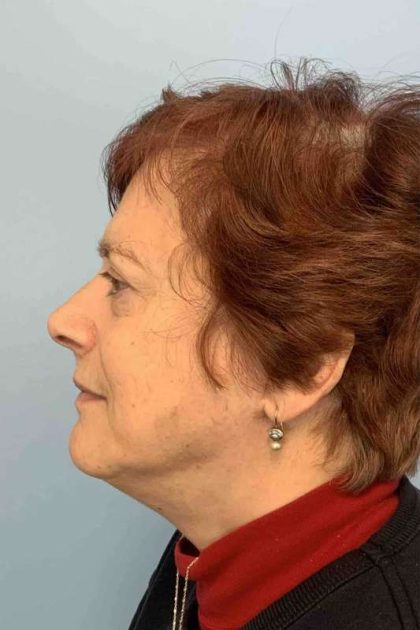 Eyelid Surgery Before & After Patient #11532