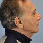 Eyelid Surgery Before & After Patient #11551