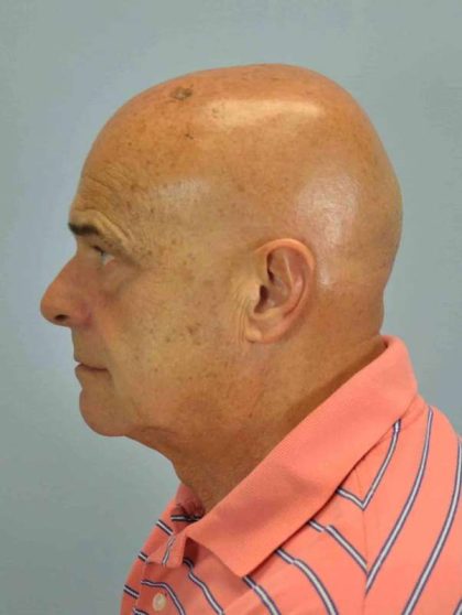 Eyelid Surgery Before & After Patient #11579