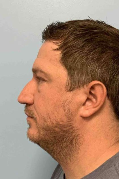Eyelid Surgery Before & After Patient #11586