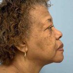 Eyelid Surgery Before & After Patient #11603