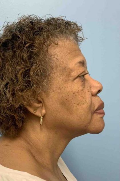 Eyelid Surgery Before & After Patient #11603
