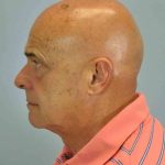 Eyelid Surgery Before & After Patient #11610