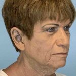 Eyelid Surgery Before & After Patient #11617