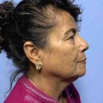 Eyelid Surgery Before & After Patient #11643