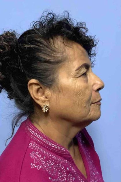 Eyelid Surgery Before & After Patient #11643