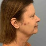 Eyelid Surgery Before & After Patient #11668
