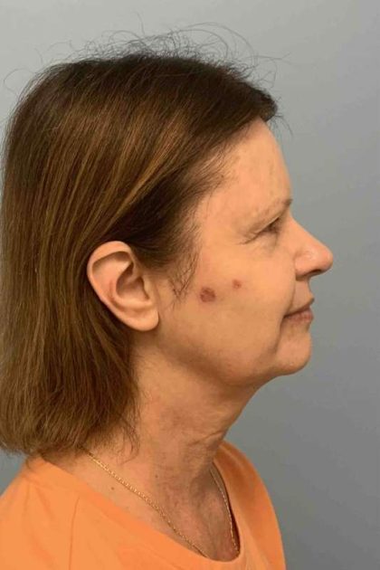 Eyelid Surgery Before & After Patient #11668