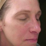 Chemical Peels Before & After Patient #11701