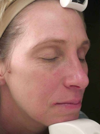 Chemical Peels Before & After Patient #11701