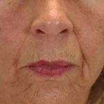Chemical Peels Before & After Patient #11704