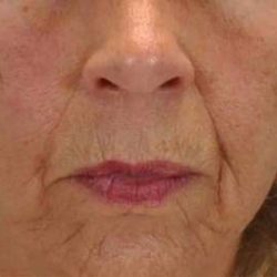 Chemical Peels Before & After Patient #11704