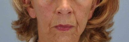 Chemical Peels Before & After Patient #11704