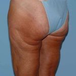 Buttocks Before & After Patient #11711
