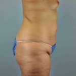 Buttocks Before & After Patient #11718