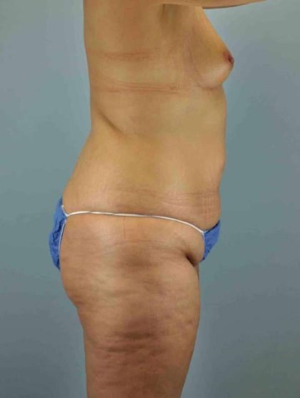 Buttocks Before & After Patient #11718