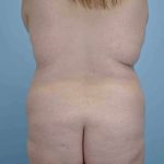Buttocks Before & After Patient #11721