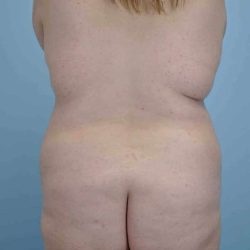 Buttocks Before & After Patient #11721