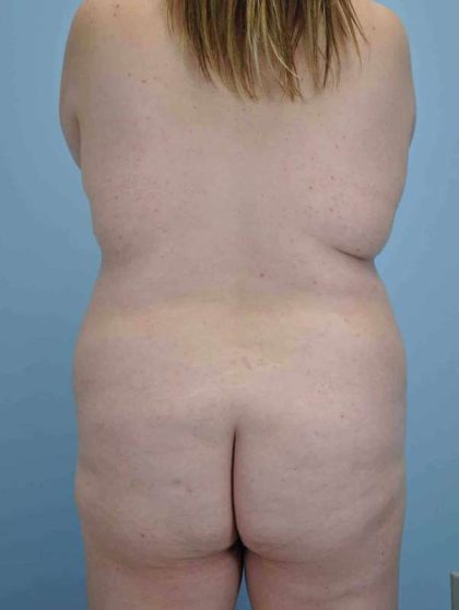 Buttocks Before & After Patient #11721