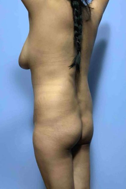 Buttocks Before & After Patient #11728