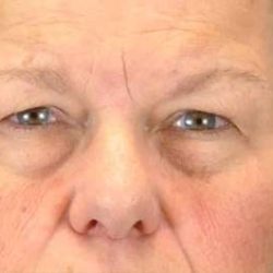 Brow Lift Before & After Patient #11801