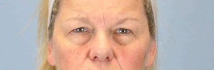 Brow Lift Before & After Patient #11801