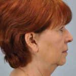 Brow Lift Before & After Patient #11815