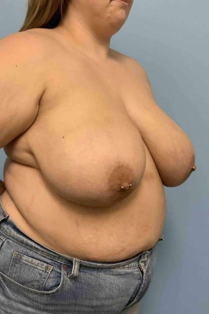 Breast Reduction Before & After Patient #11854