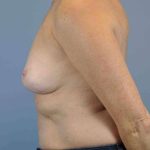 Breast Reconstruction Before & After Patient #11884