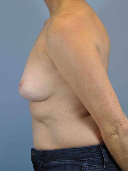 Breast Reconstruction Before & After Patient #11884