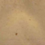 Breast Reconstruction Before & After Patient #11887