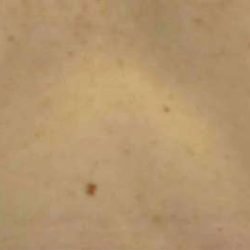 Breast Reconstruction Before & After Patient #11887