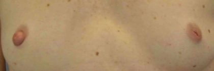 Breast Reconstruction Before & After Patient #11887