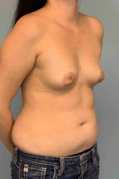 Breast Reconstruction Before & After Patient #11894