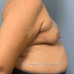 Breast Reconstruction Before & After Patient #11901