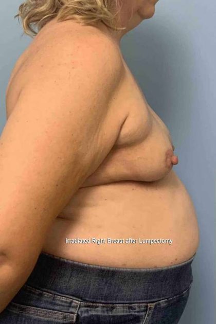 Breast Reconstruction Before & After Patient #11901