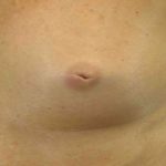 Breast Reconstruction Before & After Patient #11908