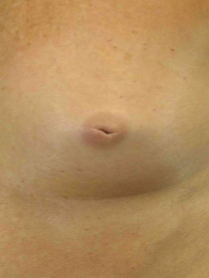 Breast Reconstruction Before & After Patient #11908