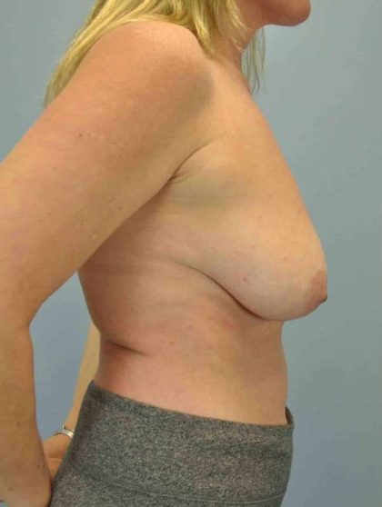 Breast Reconstruction Before & After Patient #11919