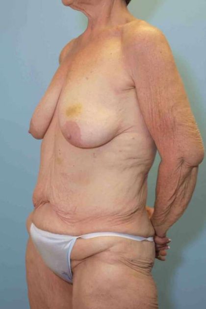 Breast Lift Before & After Patient #11957