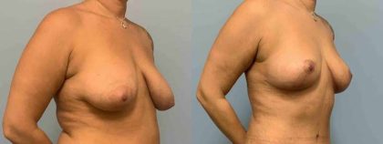 Breast Lift Before & After Patient #11973