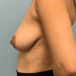 Breast Lift Before & After Patient #12042