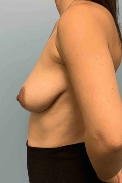 Breast Lift Before & After Patient #12042