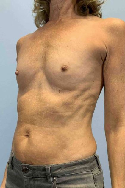 Breast Augmentation Before & After Patient #12049
