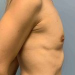 Breast Augmentation Before & After Patient #12056