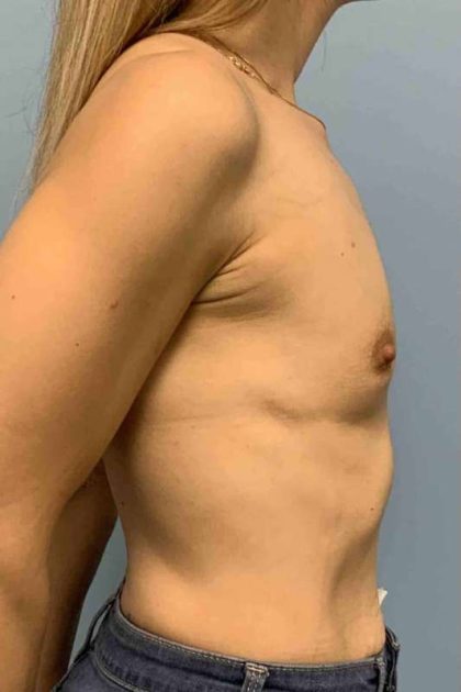 Breast Augmentation Before & After Patient #12056
