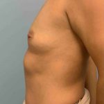 Breast Augmentation Before & After Patient #12063