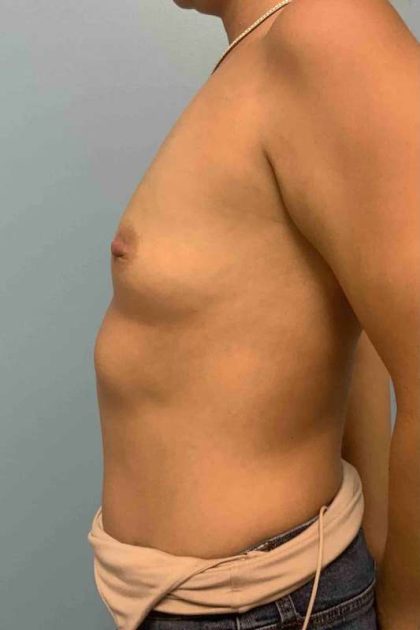 Breast Augmentation Before & After Patient #12063